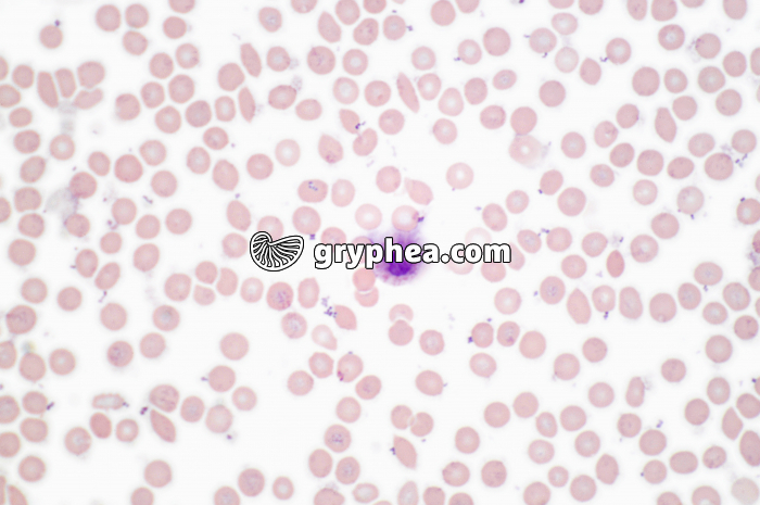 Septicémie dans sang x200 - gryphea.org